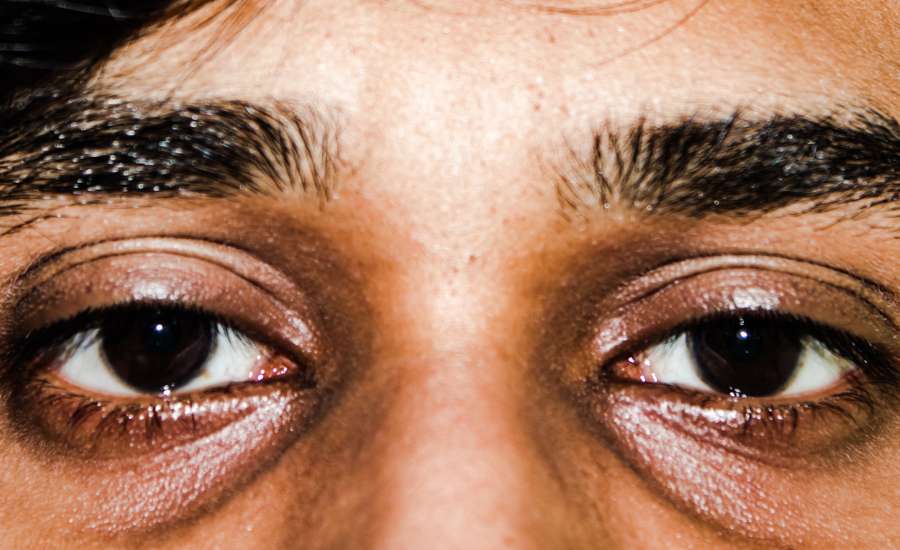 Blefaroplastia superior e inferior en Alcobendas Clinica Dermaes