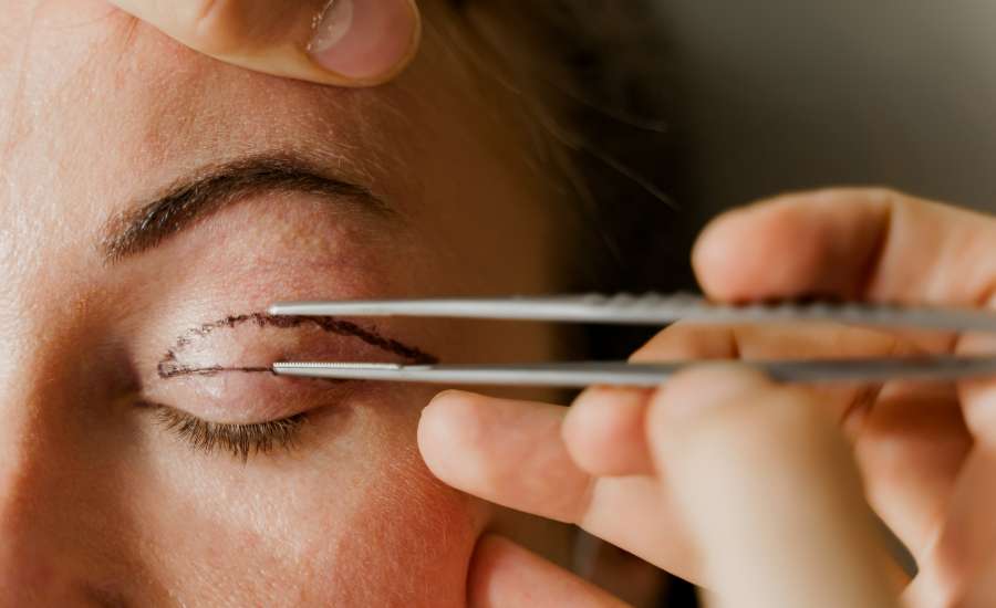 Blefaroplastia superior e inferior en Alcobendas Clinica Dermaes