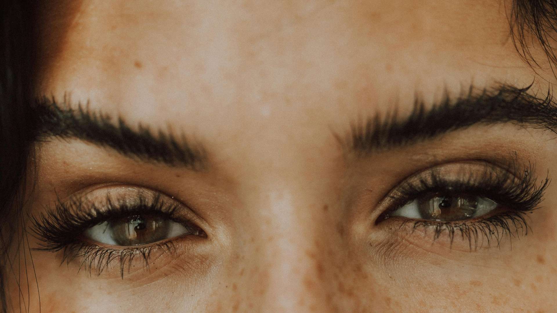 Blefaroplastia ojeras en Alcobendas