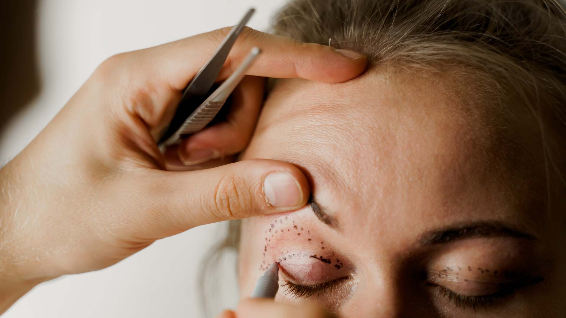 Blefaroplastia en párpado superior en Alcobendas Madrid