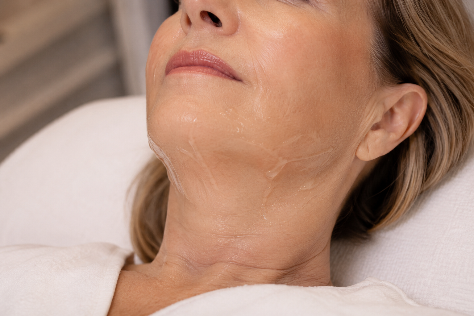 Resultados de Ultherapy en el óvalo facial y el cuello